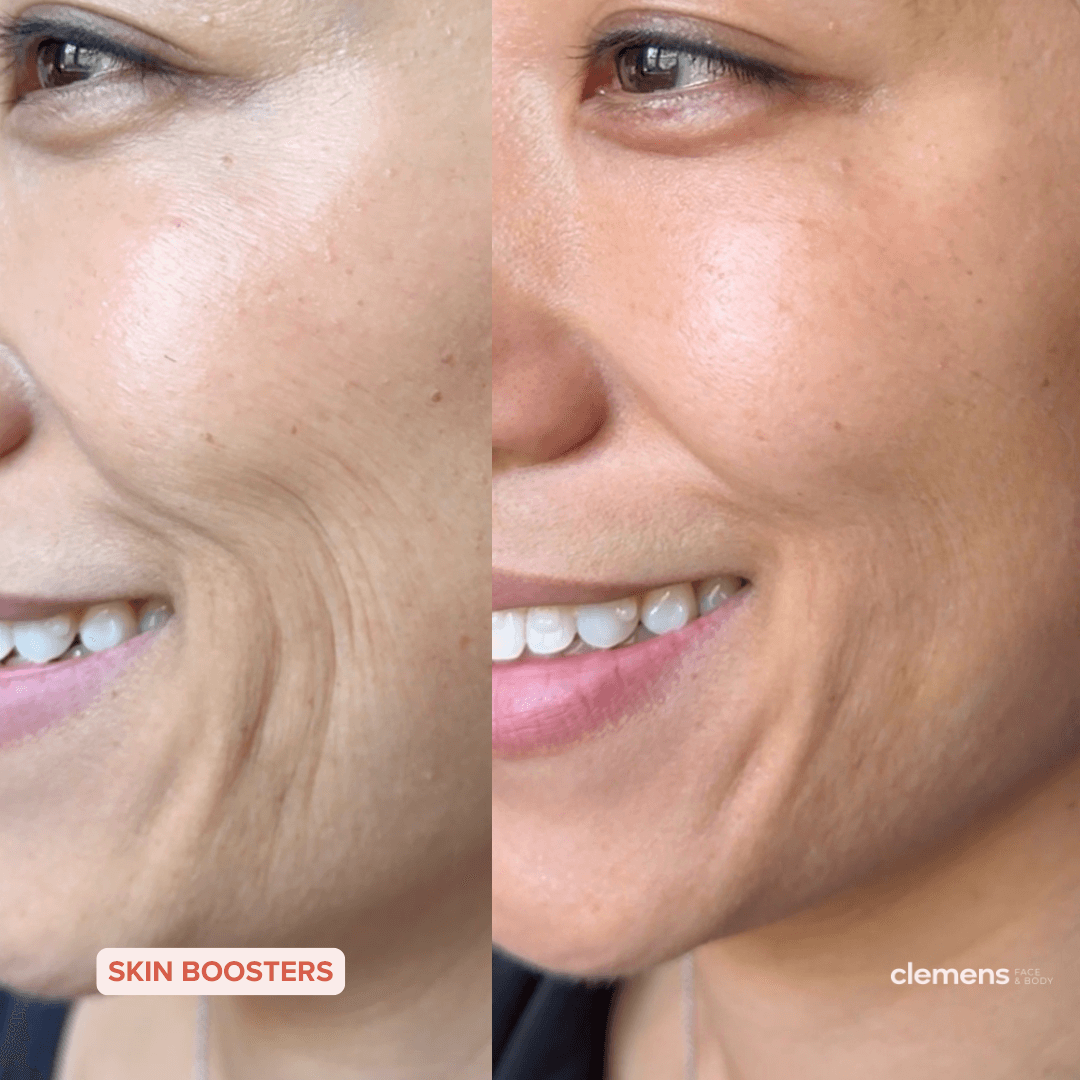 Close-up of a woman's face showing a before and after comparison of skin texture. The left side shows skin with visible lines and uneven texture, while the right side displays smoother, clearer skin. The text overlay reads 'Skin Boosters' and 'Clemens Face & Body'.