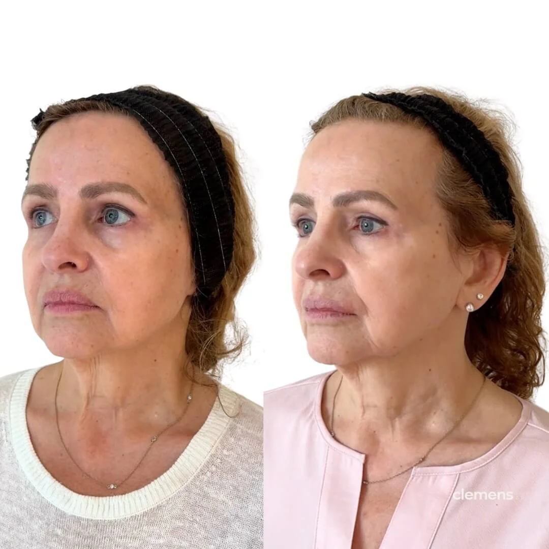 Before and after images of a middle-aged woman showing reduced signs of aging on her face, with visible improvements in skin texture and wrinkle reduction following Sculptra