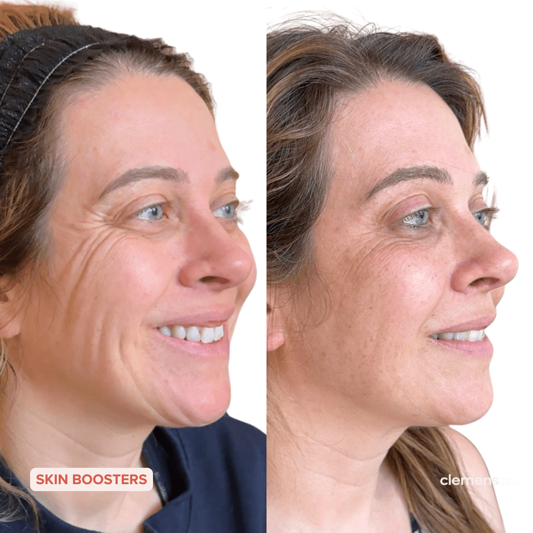 Side-by-side comparison of a Caucasian woman's face showing improvement in her smile lines