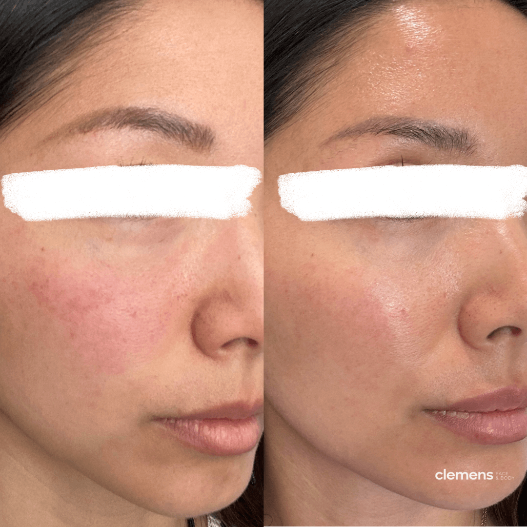 Microneedling Vs Skin Boosters Which Is Right For You Boston Microneedling Vs Skin Boosters Which Is Right For You Boston
