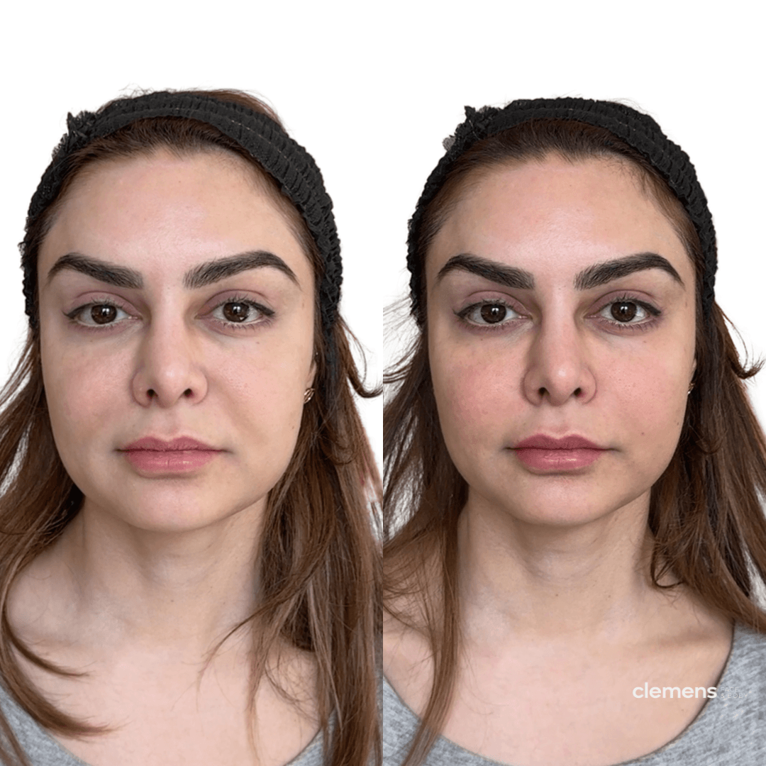 Treatment: Nasolabial fold filler, under-eye filler