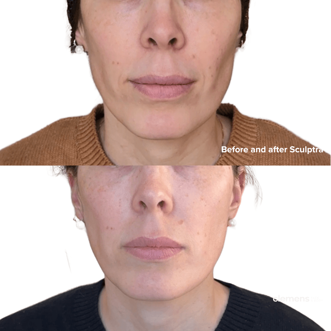 Before and after Sculptra collagen stimulator treatment showing subtle lower face rejuvenation, improved facial volume, and softened nasolabial folds with natural-looking results.