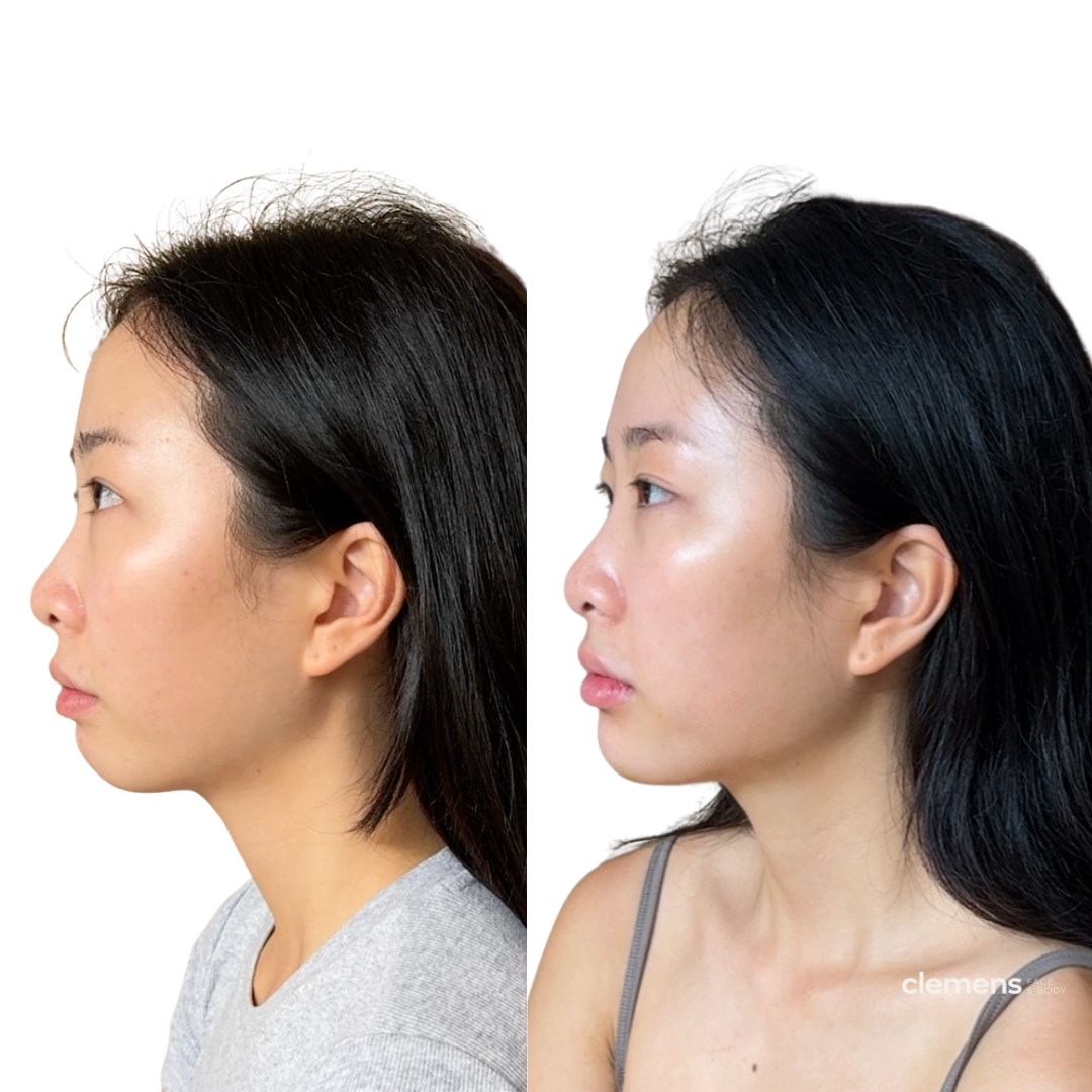before-and-after-chin-and-jawline-filler-boston-ct.png
