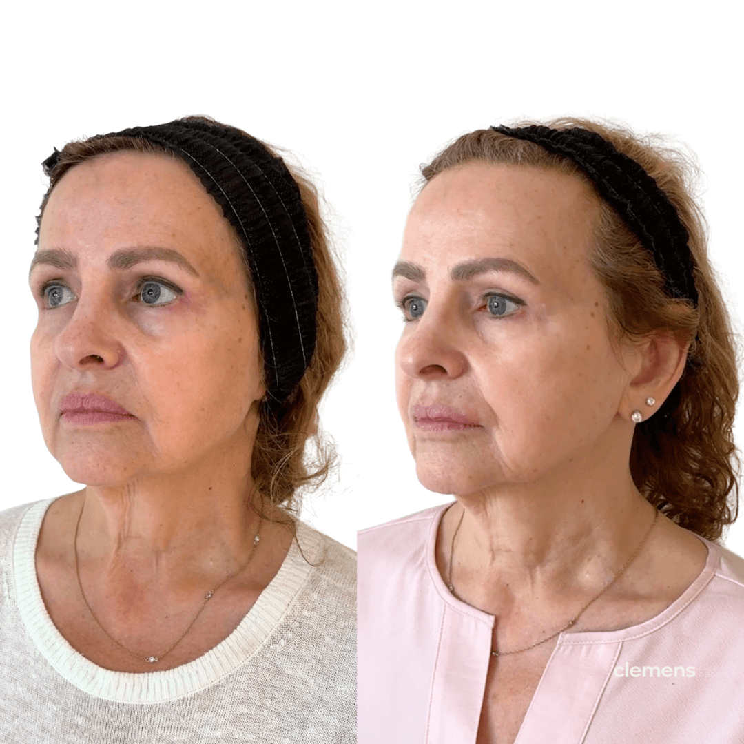 Subtle facial volume with Sculptra