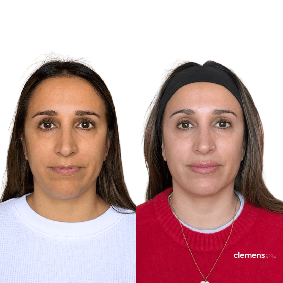 Before and after jawline and chin filler treatment improving lower face definition and facial balance