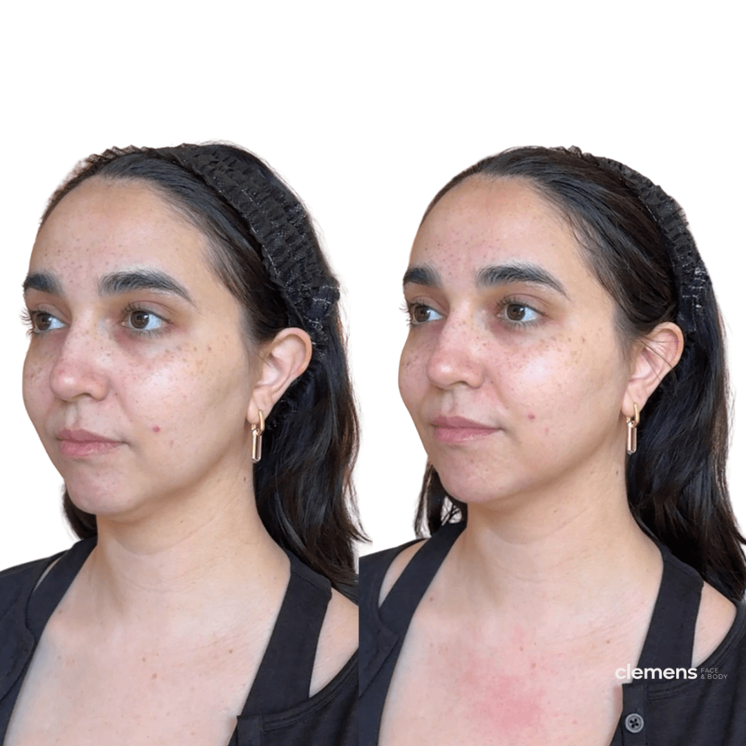 Side-by-side comparison of a woman's face showing before and after skin treatment, highlighting a sharper jawline.