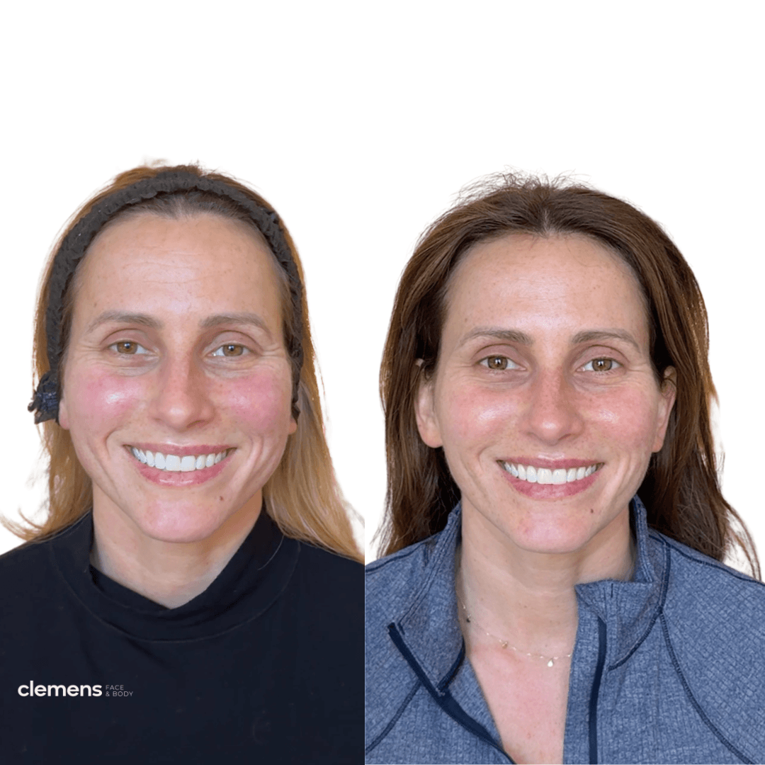 Full face rejuvenation treatment softening signs of aging while preserving natural features