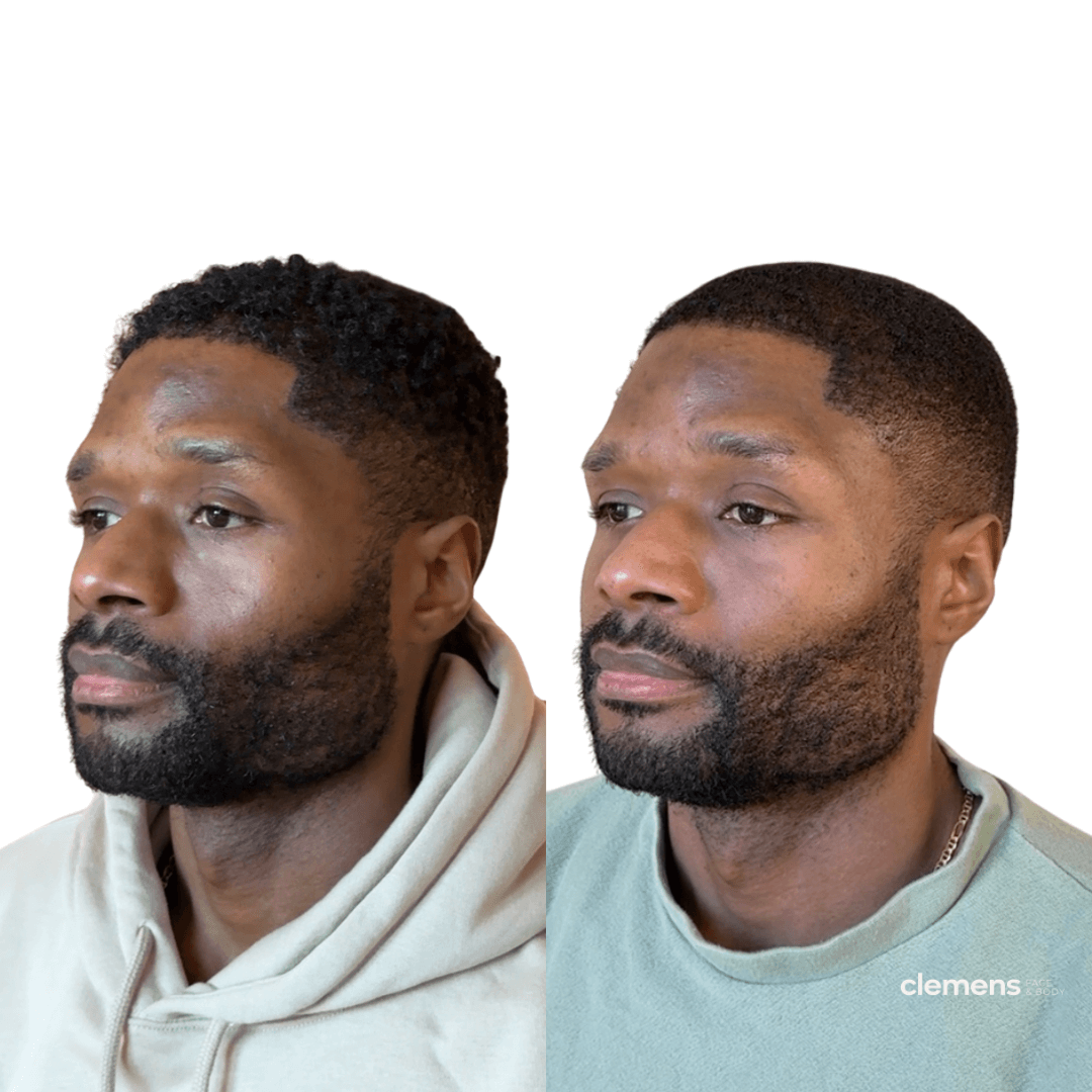 Side-by-side comparison of a man before and after facial balancing with under eye fillers, showing improvement in his under eye hollows