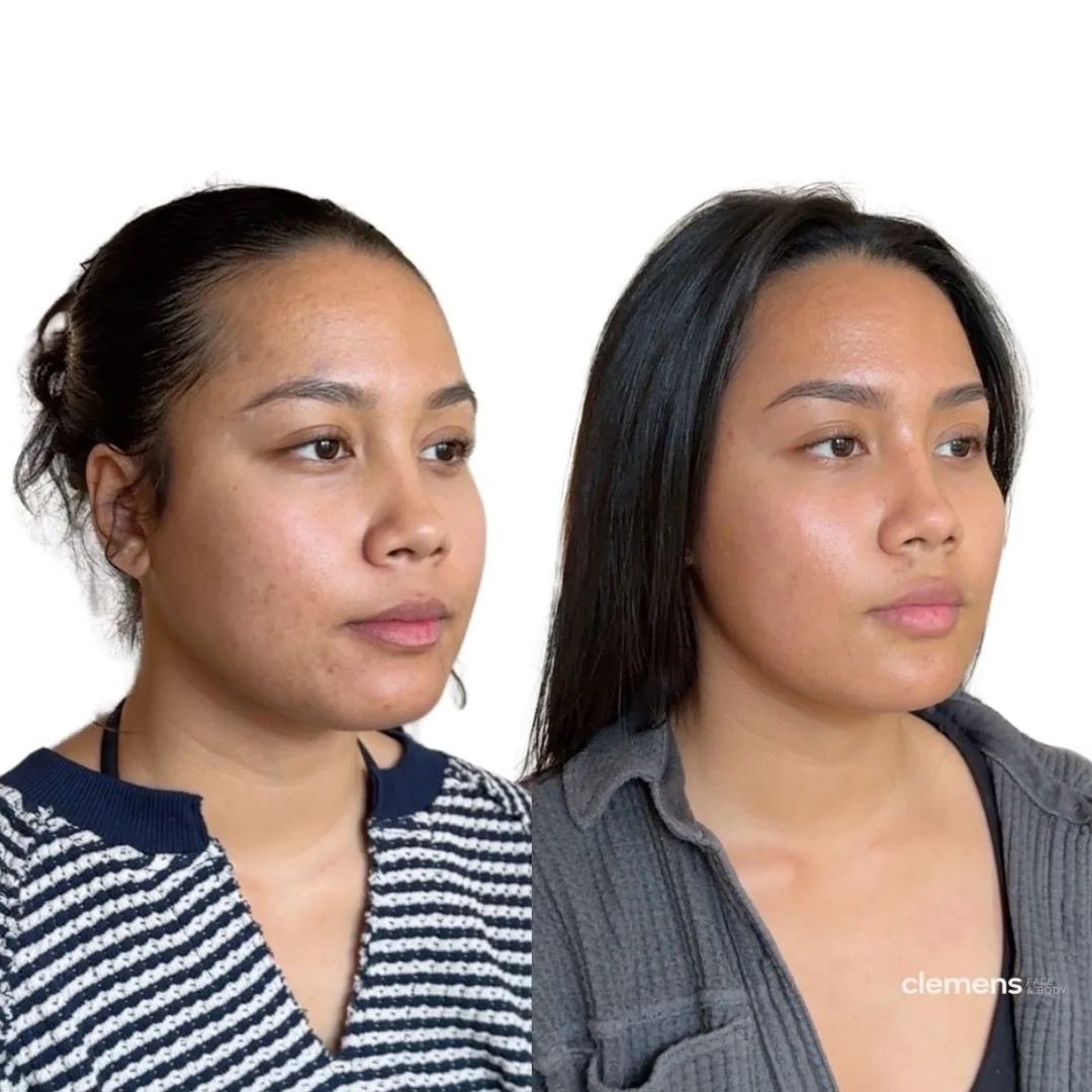 Slimmed and structured. Cheek and chin filler, jawline refinement, and lip filler eased mid-face flatness and lower-face heaviness for real harmony.