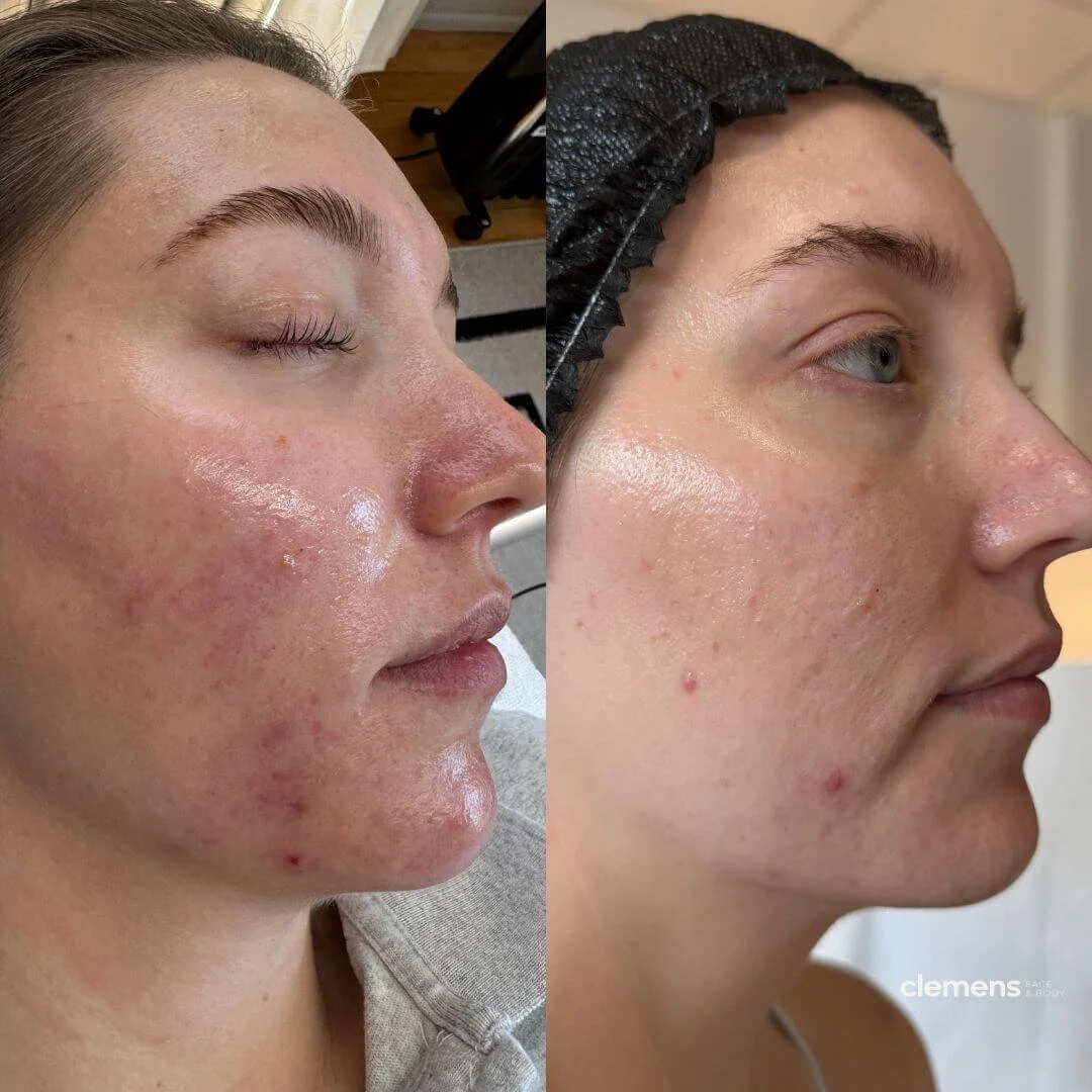 Concerns: Redness, inflammation, acne, and scarring