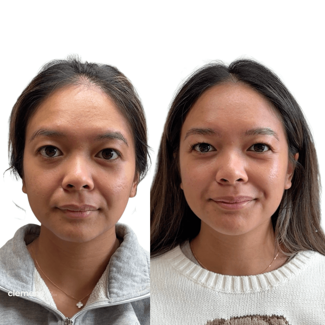 Before and after chin filler treatment improving lower face balance and projection