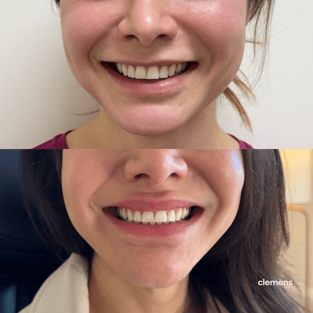 Close-up of a woman smiling, showing their teeth, with the top woman having a broader smile and fuller upper lip