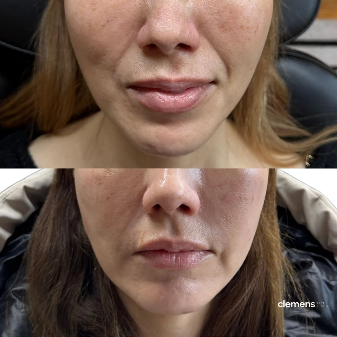 Treatment: Nasolabial folds filler