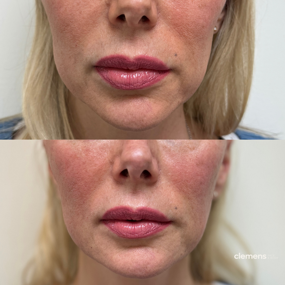 Close-up of a woman's face, showing lips before and after a cosmetic procedure, with noticeable improvement in facial shape.