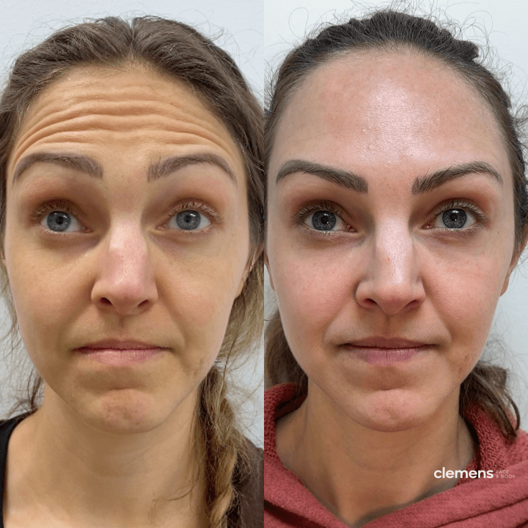 Forehead Dysport (wrinkle relaxers)