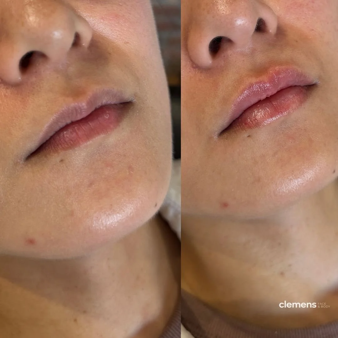 Treatment: Lip filler