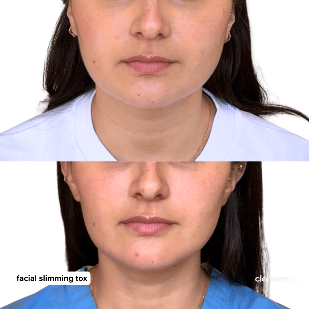 Before and after images showing facial slimming treatment with tox, woman with dark hair and fair skin, dressed in white and blue tops.