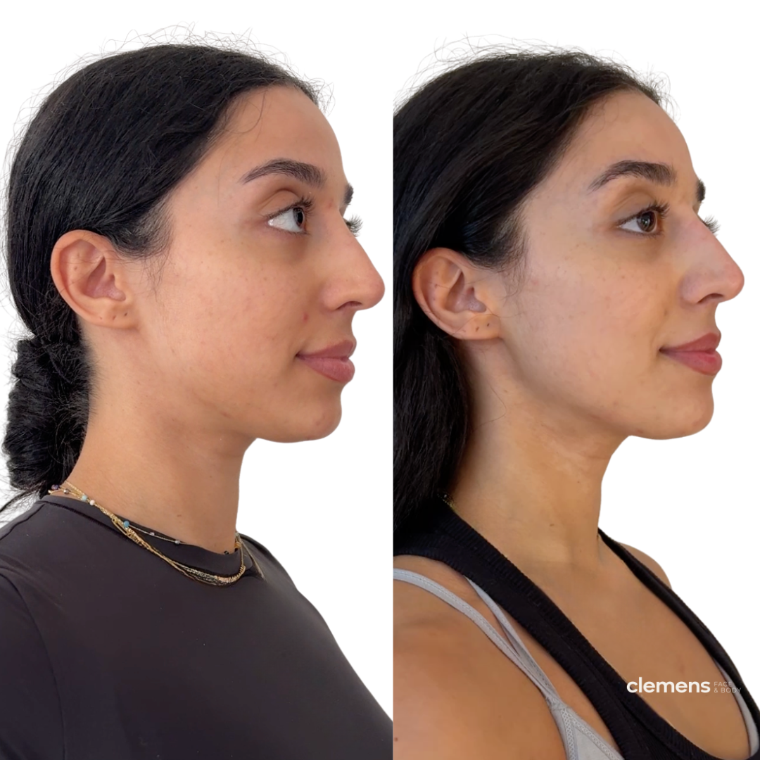 before-and-after-jawline-filler-boston-ca.png