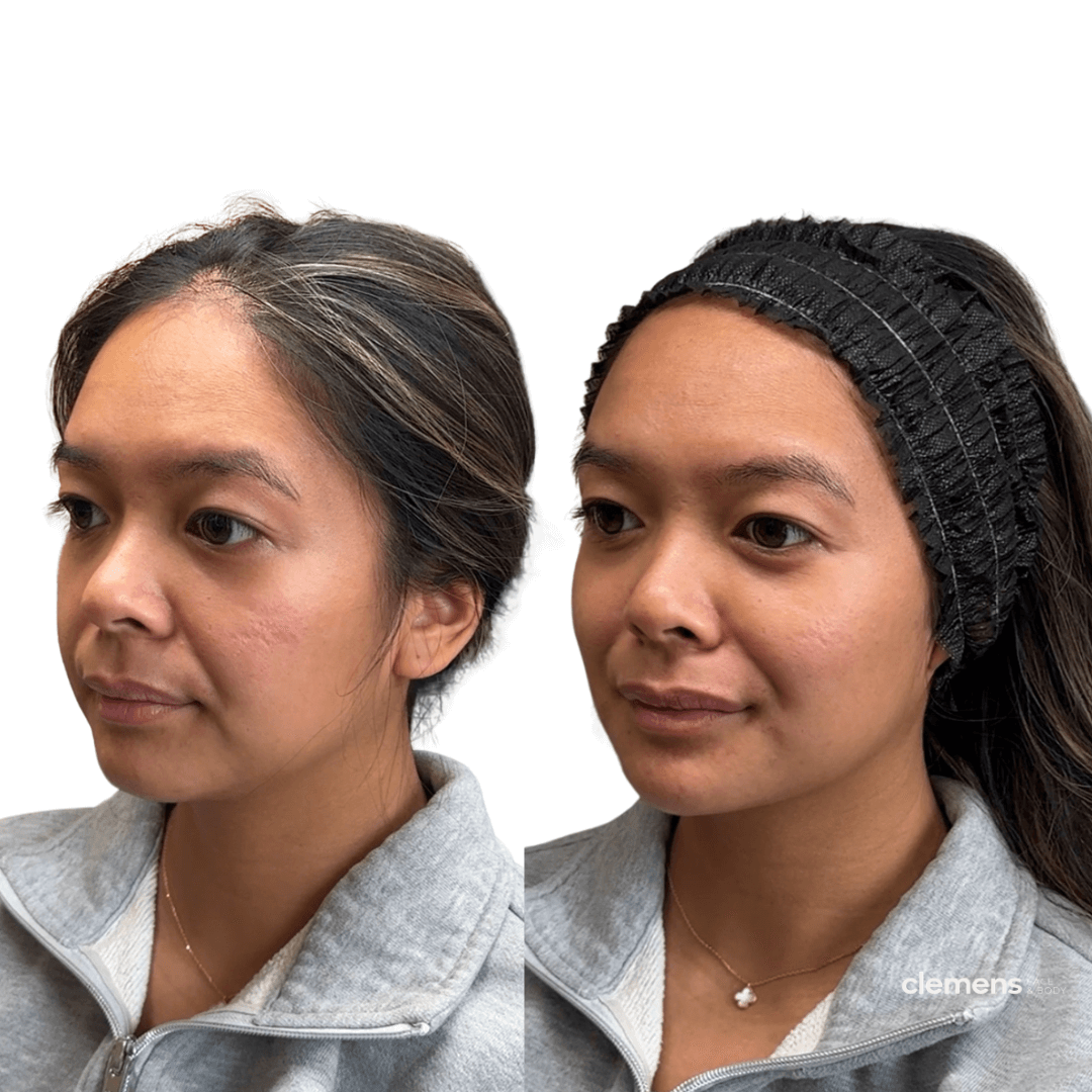 Side-by-side comparison of a woman before and after facial treatment, wearing a gray jacket, with the after image showing an elongated chin, smoother complexion and wearing a black headband.
