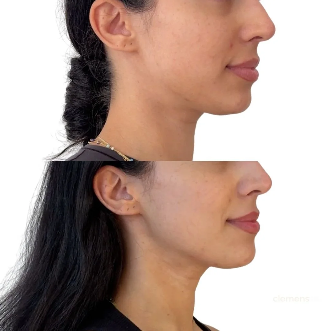 Jawline and jowl filler to enhance her side profile