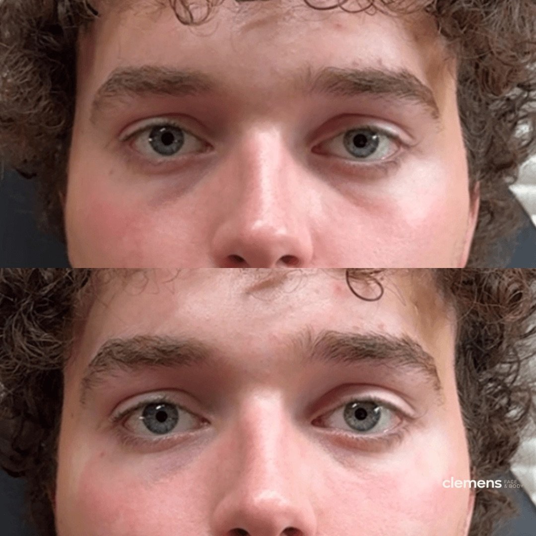 Treatment: Under-eye filler