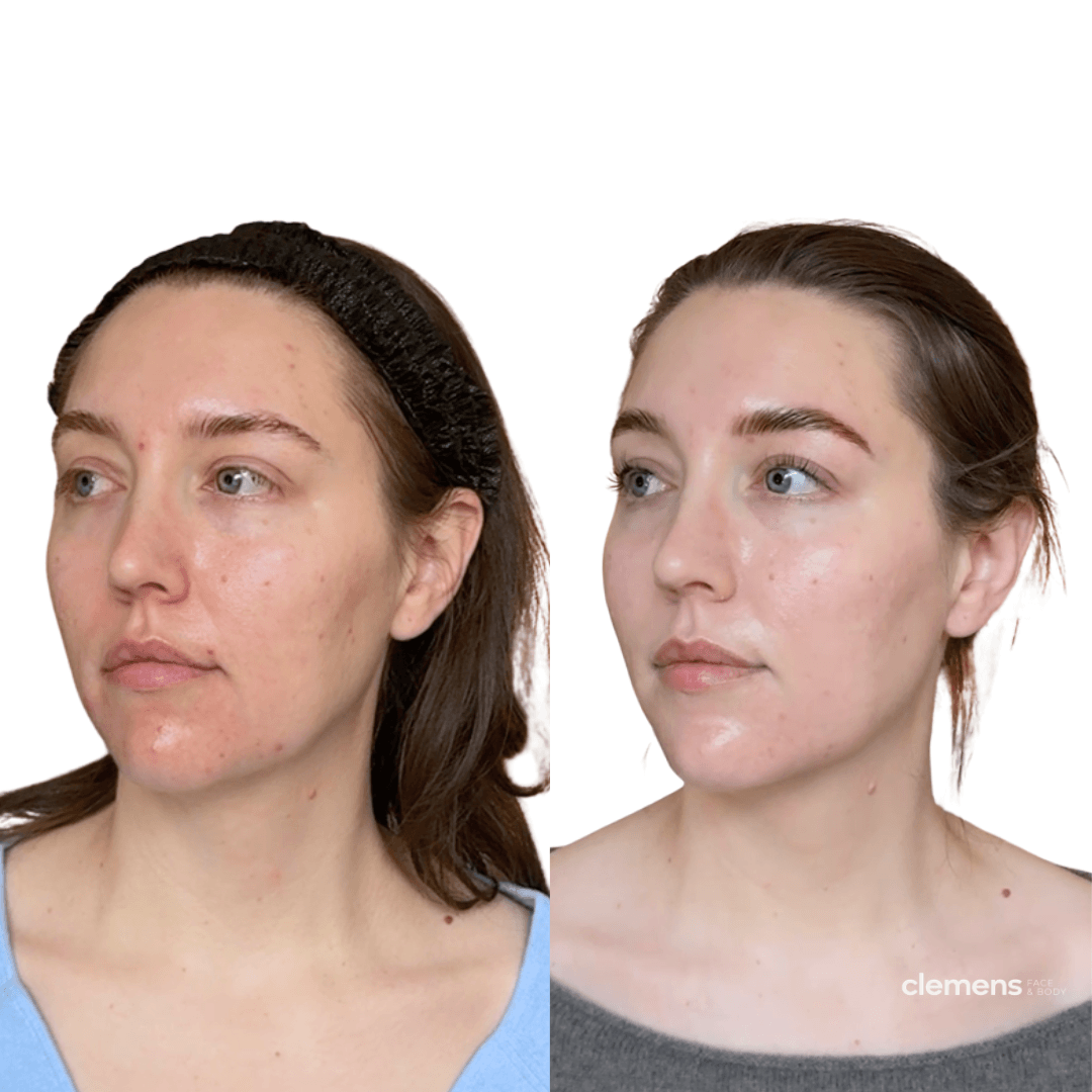 Side-by-side comparison of a woman before and after skincare treatment, showing improved skin condition.