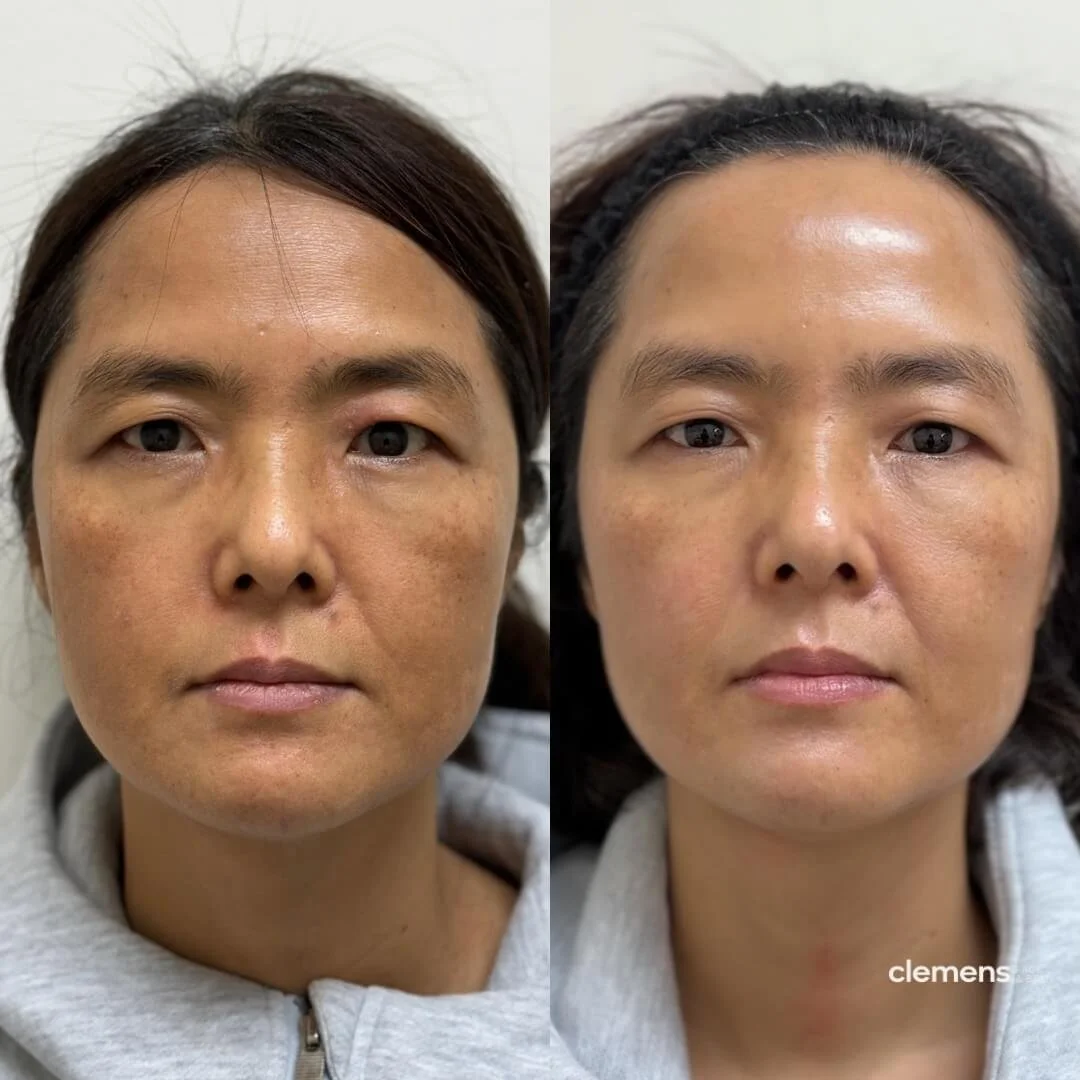 Side-by-side comparison of a woman's face before and after Sculptra treatment, showing reduced dark spots and brighter skin.