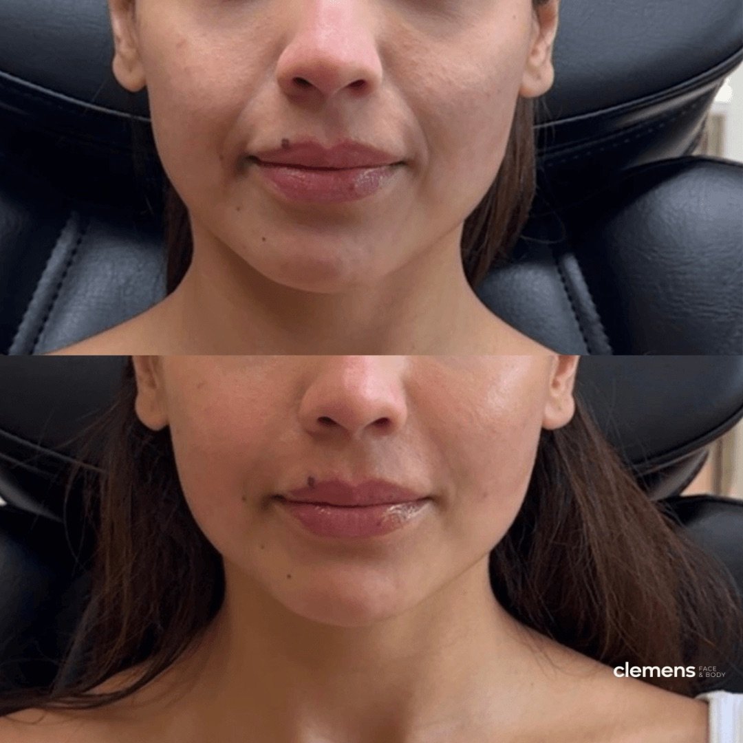 Side by side comparison young woman showing improvement in her smile lines, cheeks, and under eyes after filler procedure.