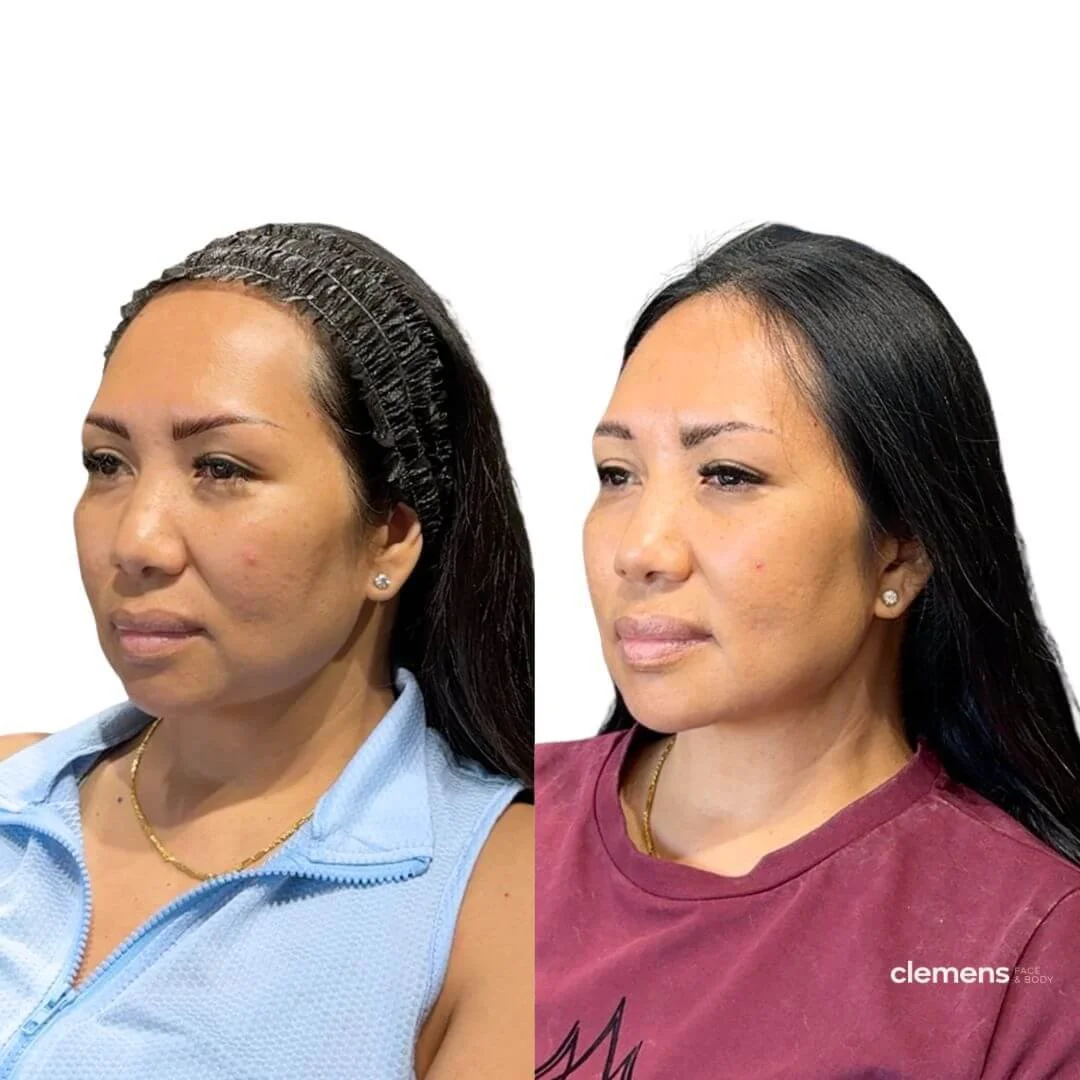Losing her lower face in her forties. We helped restore structure, definition, and elongation by treating her chin, jowls, and jawline.