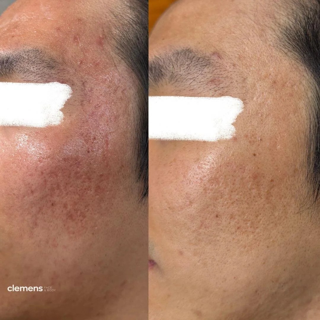Concerns: Acne scars, redness, breakouts
