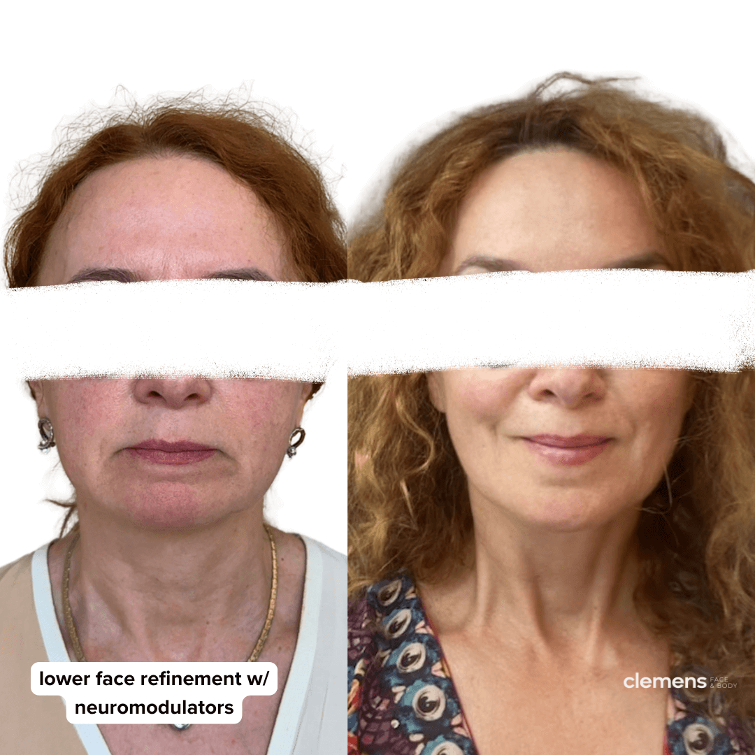 Side-by-side comparison of two women before and after lower face refinement with neuromodulators, showing smoother jawlines and improved facial appearance.