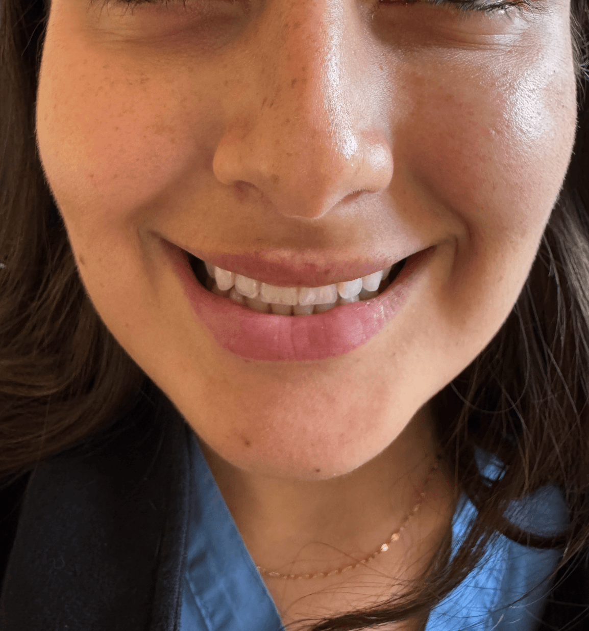 Image of someone's smile with full limps and a singular lip lump post-lip filler