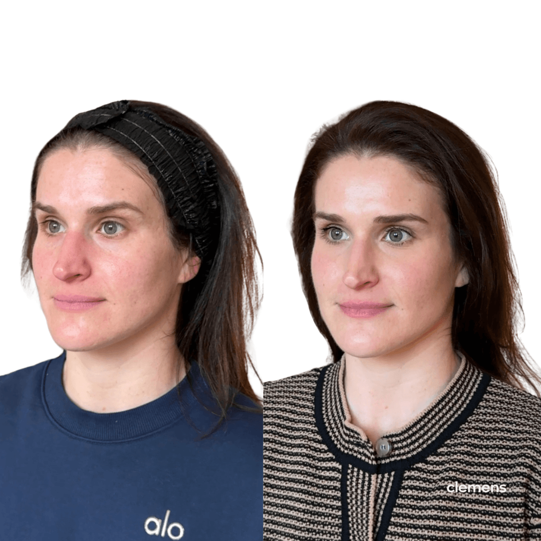 Before and after full face rejuvenation with natural-looking dermal filler results
