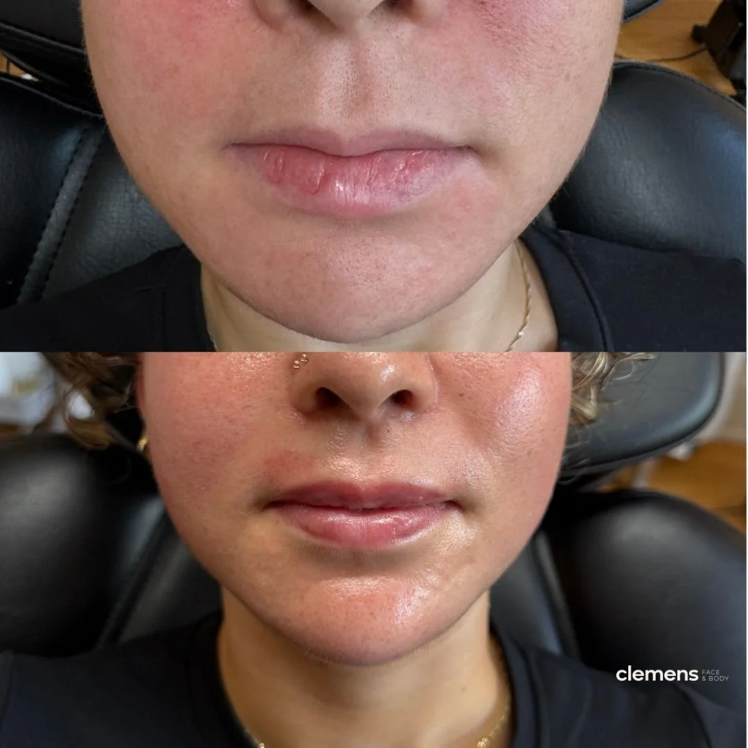 Treatment: Lip filler