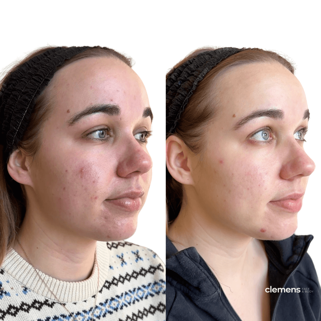 Side-by-side comparison of a woman's face before and after microneedling with PDRN, showing improved skin clarity and texture.