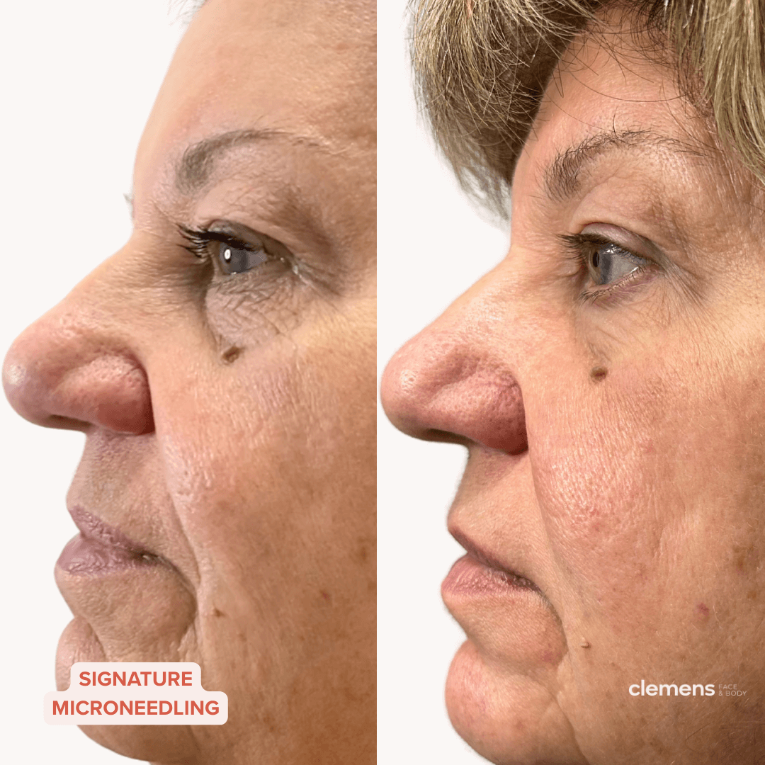 Side-by-side comparison of a woman's face before and after microneedling treatment showing improved skin texture and reduced wrinkles.