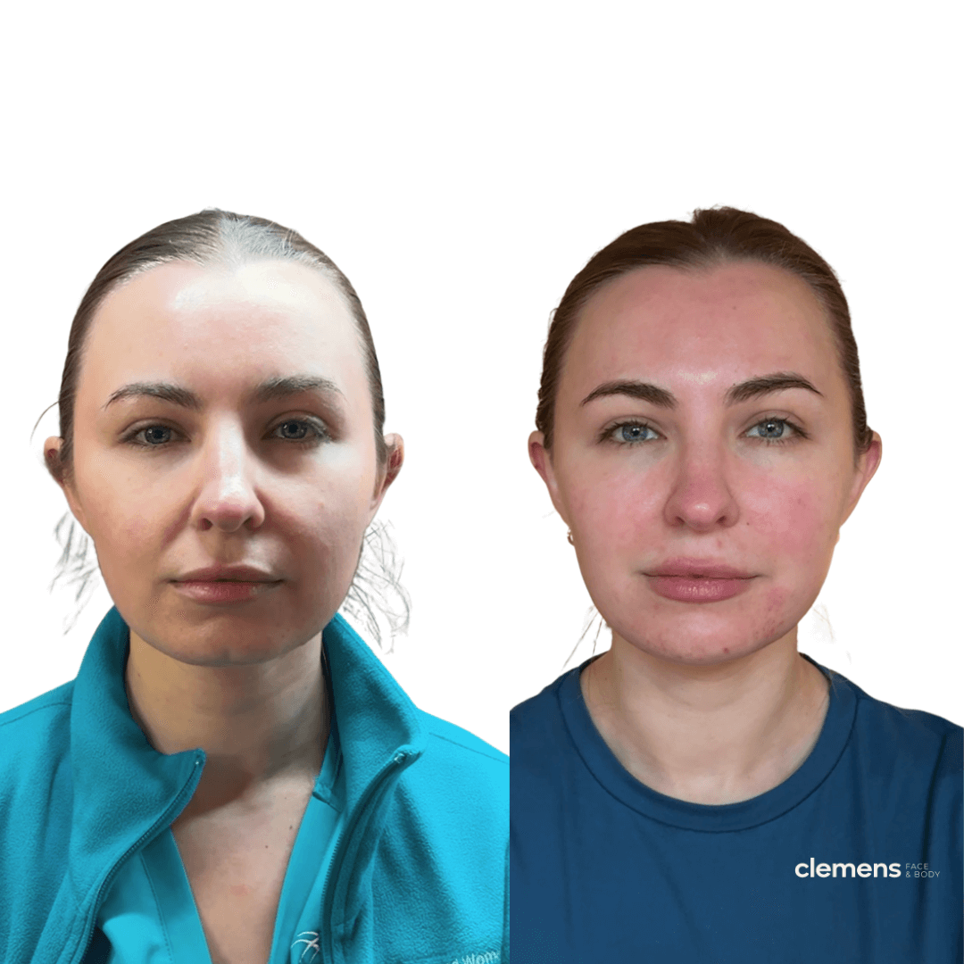 Comparison of a woman before and after skincare treatment showing improved facial appearance.