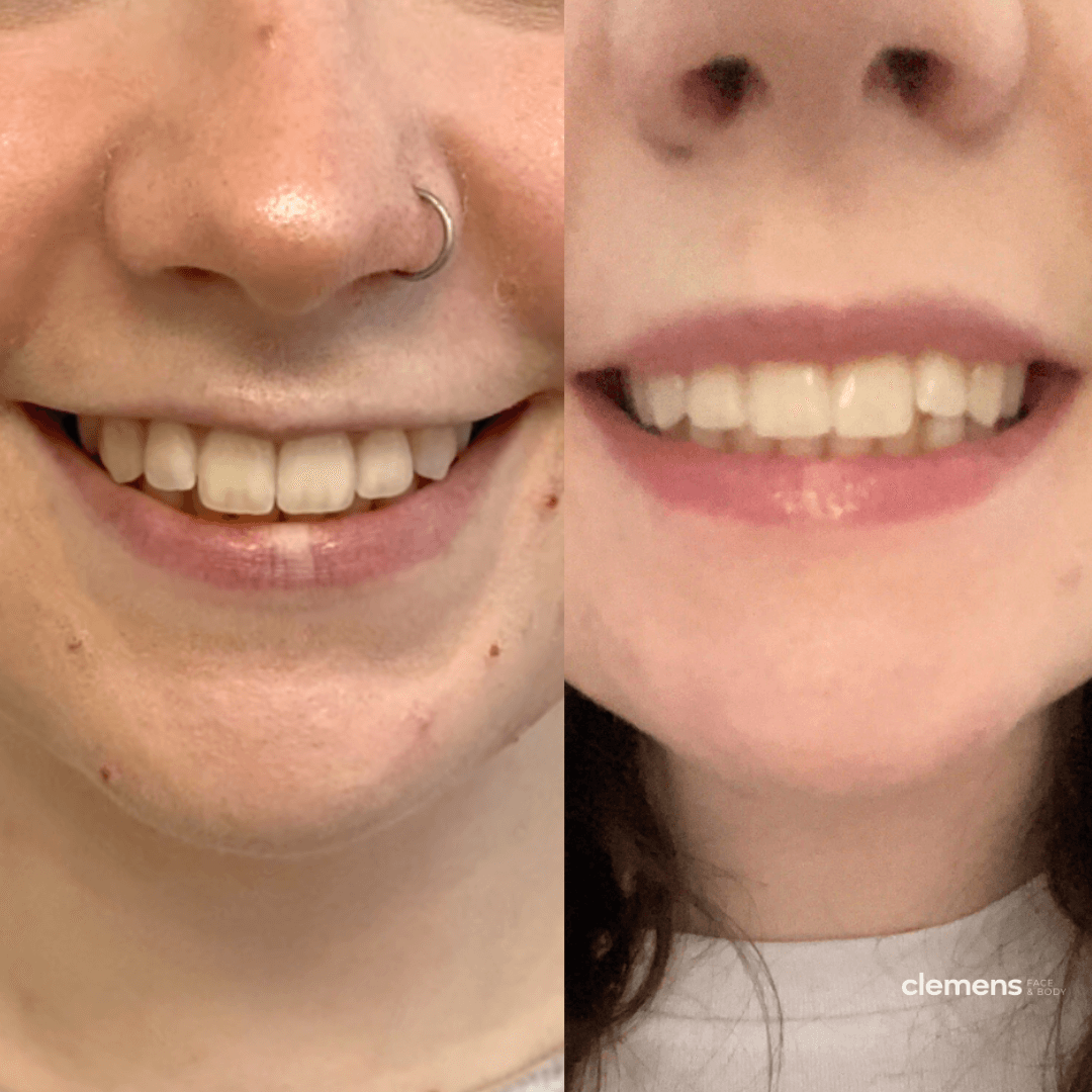 Close-up of two smiling faces showing their teeth and fuller lips after a lip flip.