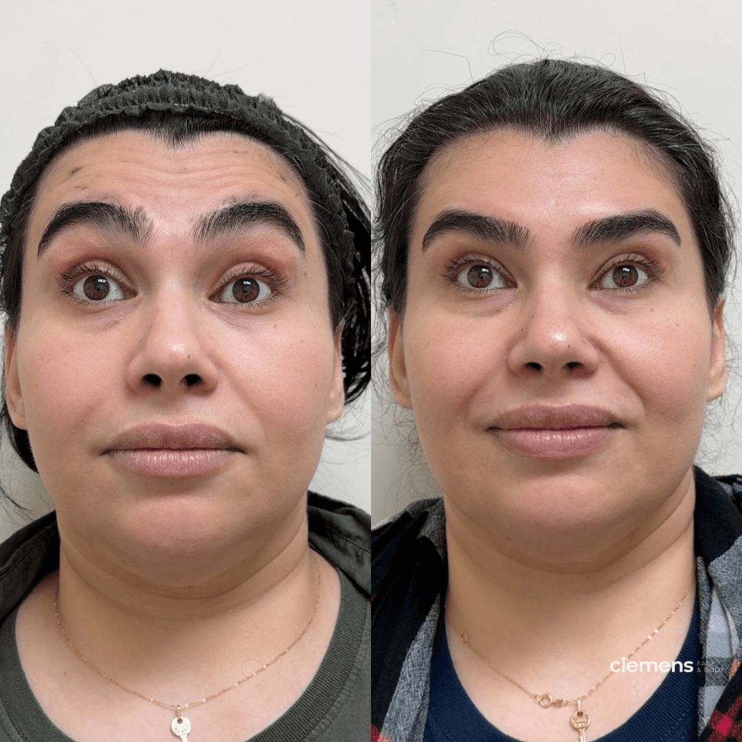 Forehead Dysport for forehead lines