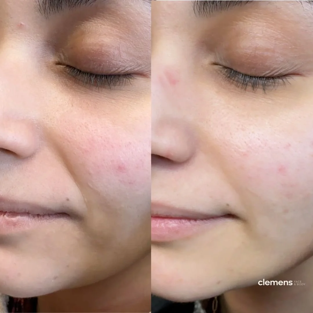 Treatment: Nasolabial folds filler