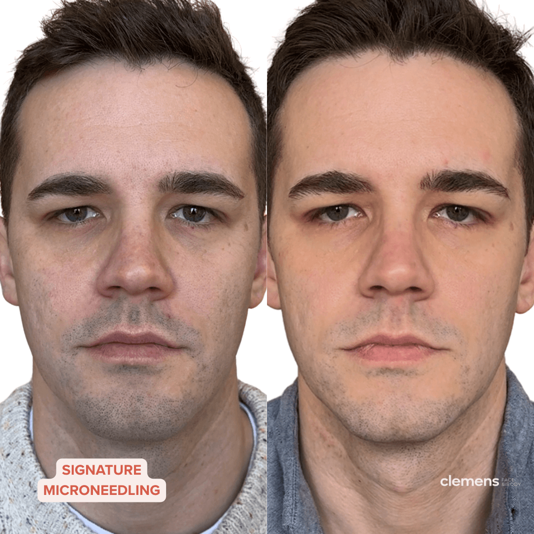 Comparison of a man's face before and after a cosmetic treatment, with visible reduction in skin imperfections on the right side.