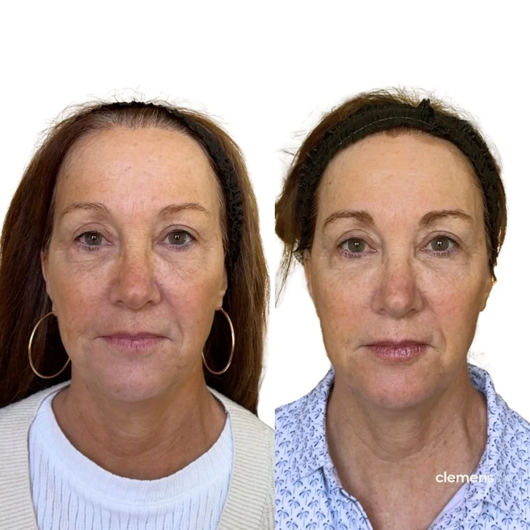 Facial balancing, lip filler, forehead Dysport