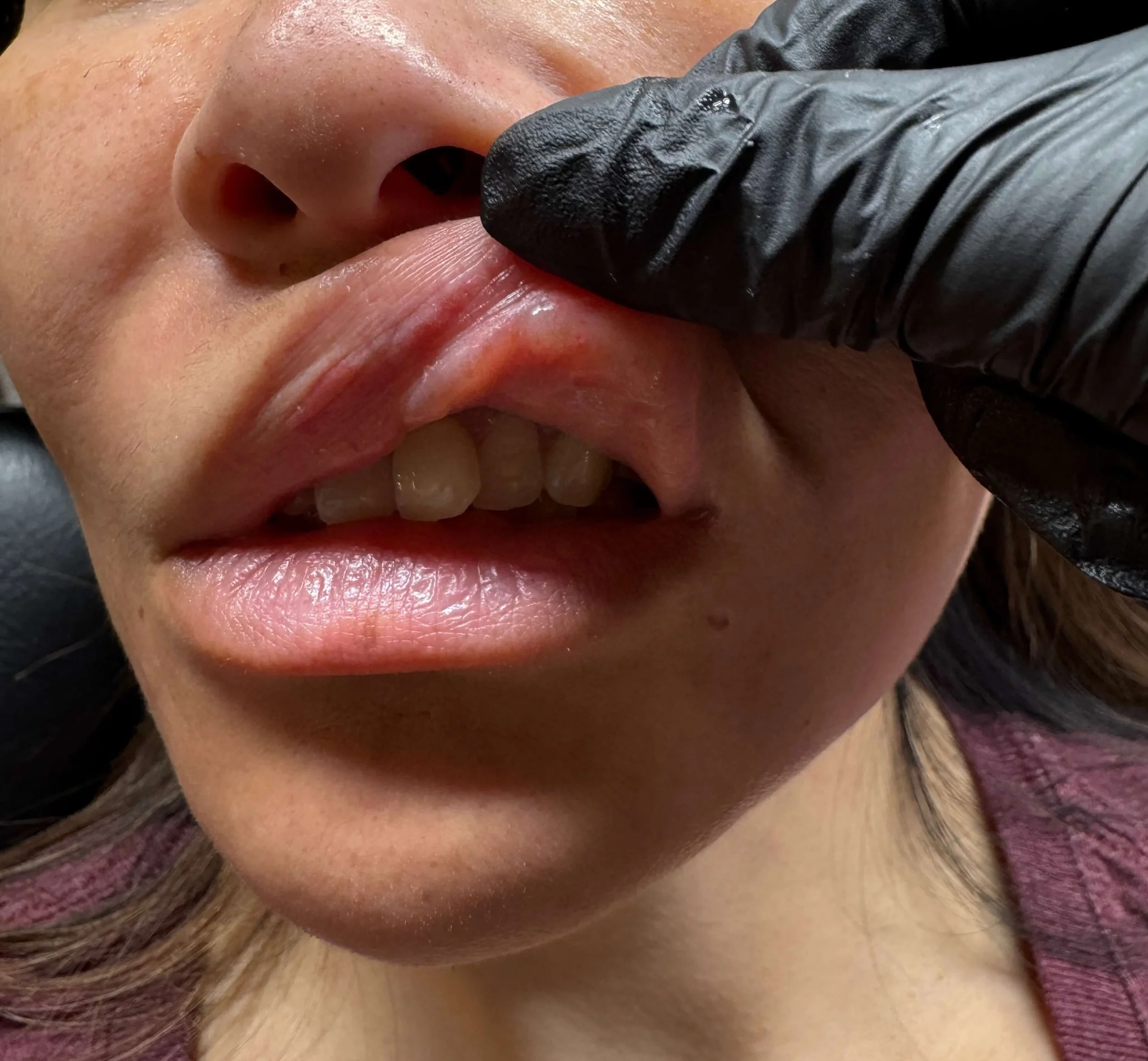 Image of a lip being pulled up and a visible lump on the the lip from lip filler
