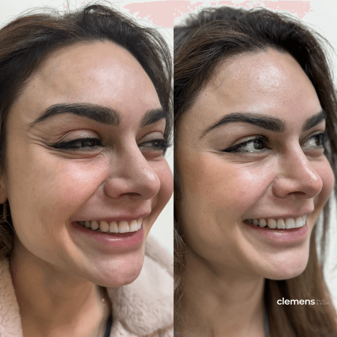Side-by-side comparison of a woman smiling before and after a cosmetic procedure, showing softened eye wrinkes
