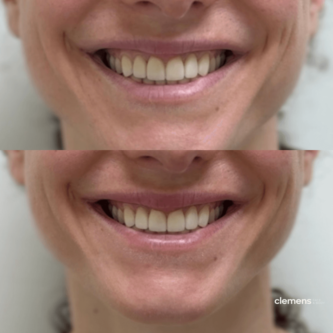 Comparison of two close-up images of a person's smiling mouth showing a fuller upper lip after receiving a lip flip.