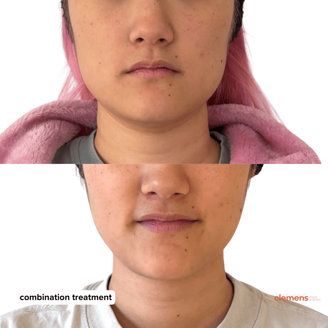Comparison of a person's face before and after combination treatment, showing improvements in skin appearance.