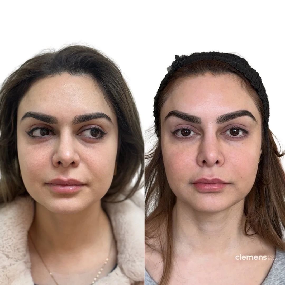 The no-makeup makeup look. Facial balancing softened under-eye hollowness, mid-face volume loss, and fine lines. A subtle lip touch finished it.