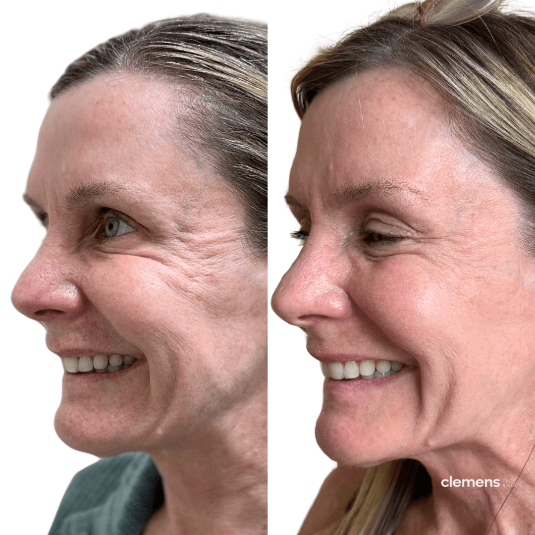 Side by side comparison of woman with improved eye wrinkles after microneedling with PDRN