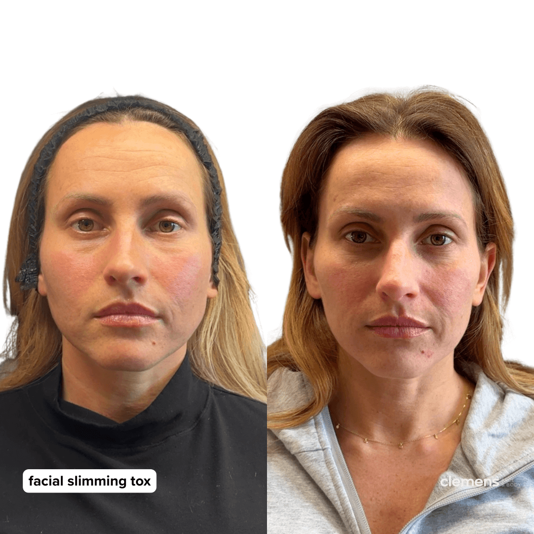 Comparison of a woman before and after facial slimming treatment, showing facial changes with the text 'facial slimming tox' on the left side.