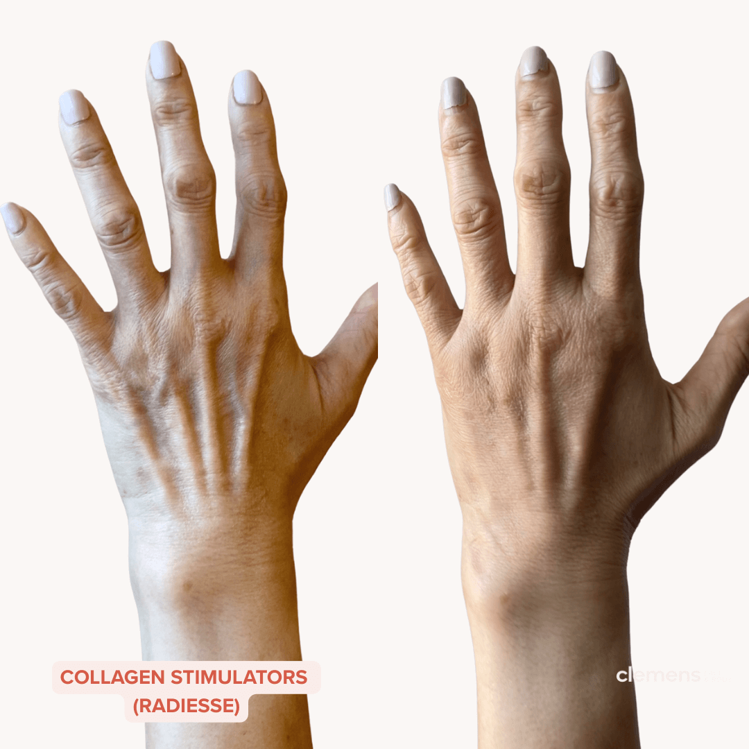 Comparison of two hands with visible veins and skin texture, with the left hand slightly more wrinkled than the right hand.